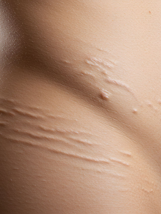 skinpen_narben