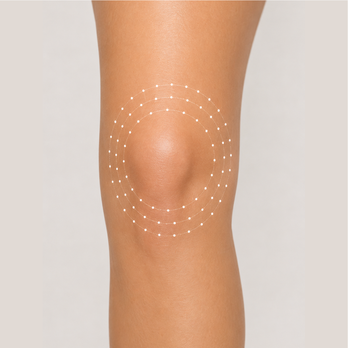 Radiofrequenzneedling Patella BEAUTYZONE KEMPTEN Radiofrequenzneedling Patella BEAUTYZONE KEMPTEN